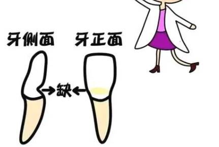 牙颈部楔状缺损怎么办?补牙后一般能维持几年?