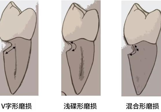 牙颈部楔状缺损怎么办?补牙后一般能维持几年?