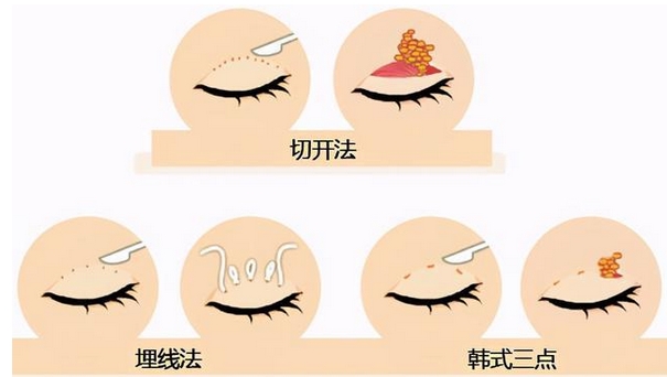 北京协和医院黄久佐做双眼皮怎么样?坐诊医院、医生简介!实现案例分享自由~