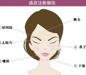 伊维兰填充除皱怎么样?原理及优势介绍!除皱后注意问题有哪些