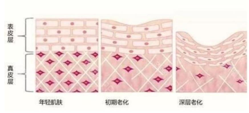 伊维兰填充除皱怎么样?原理及优势介绍!除皱后注意问题有哪些