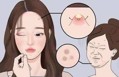 怎么去青春痘疤痕,多种方式来了解,选择哪一种比较适合吧?