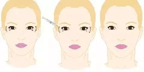 怎样减少眼部皱纹?眼部皱纹形成的原因有哪些?类型有这几种!