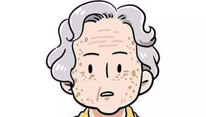 年轻人也会长老年斑吗?老年斑是如何形成的呢?
