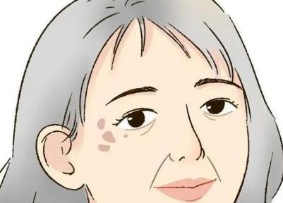 年轻人也会长老年斑吗?老年斑是如何形成的呢?