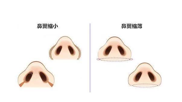 缩鼻头会有后遗症吗?这4点注意事项要记住!!