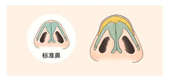 缩鼻头会有后遗症吗?这4点注意事项要记住!!