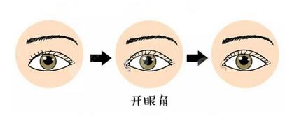 开眼角有风险吗?来看看开眼角手术的注意事项!