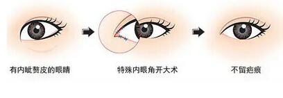 开眼角有风险吗?来看看开眼角手术的注意事项!