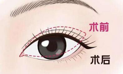 开眼角有风险吗?来看看开眼角手术的注意事项!