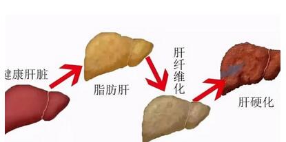 脂肪肝吃什么才能减掉肝上的脂肪?脂肪肝求美有哪些注意事项