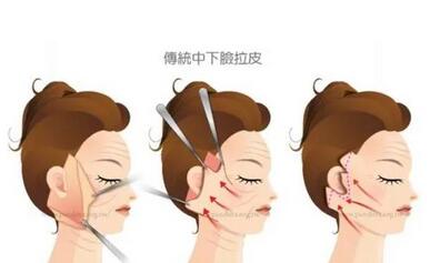 北京协和整形科专家|来看看拉皮除皱案例如何!