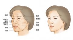 广州曙光做自体脂肪填充脸部果如何？皱纹、苹果肌凹陷怎么改良？自体脂肪填充方式测评！