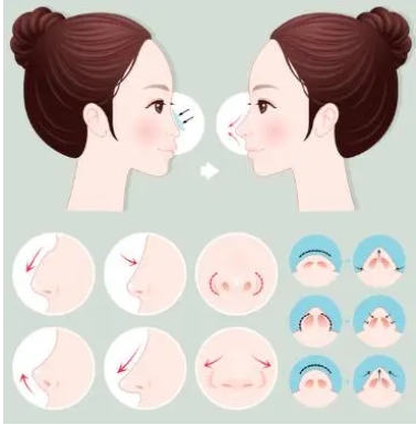 北京鼻部整形哪家医院好?润美玉之光、华美、薇琳等都很nice!特色鲜明~
