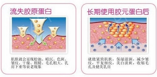 注射胶原蛋白的副作用和注意事项?注射费用及优缺点分析,值得拥有~