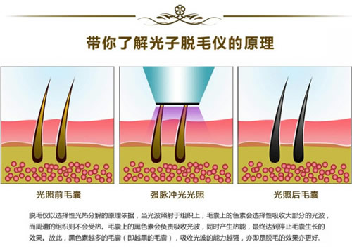 韩式脱毛还会长出来吗?多少钱?注意事项汇总!