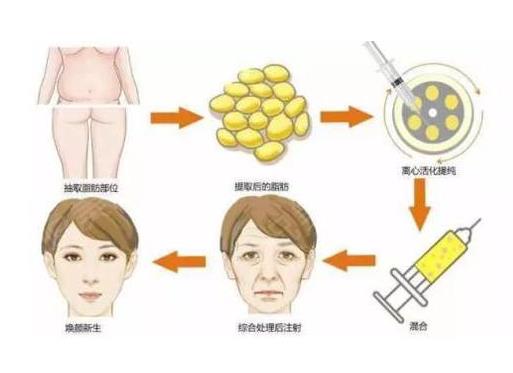 中信惠州医院整形科怎么样?陈虹医生简介_全脸脂肪填充案例展示