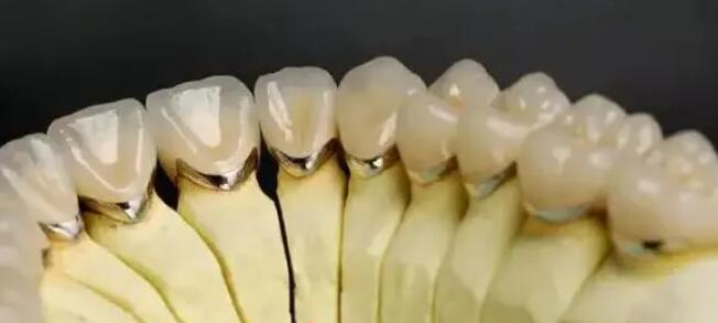 全瓷牙一颗大概多少钱?费用贵不贵?影响因素分析!