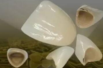 全瓷牙一颗大概多少钱?费用贵不贵?影响因素分析!