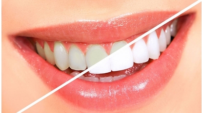 冷光牙齿美白对牙齿伤害有多大？修复牙齿是方式有哪些？原理是怎么样的呢？ 