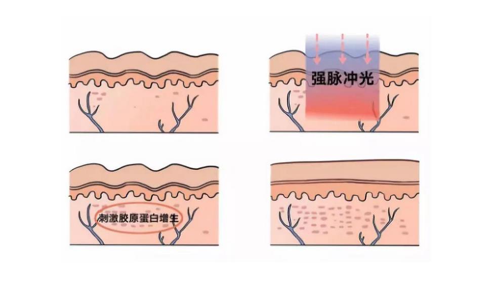 收缩毛孔的较佳方法有哪些?控油洗面奶、果酸焕肤、光子嫩肤等!