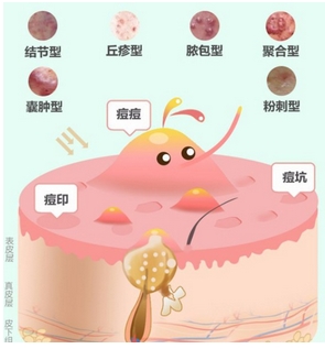 十滴水和甲硝唑凝胶能去粉刺是真的吗?粉刺皮肤的日常护理也很重要!