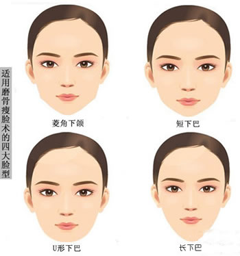 广东美恩磨骨案例(近期网友投稿):脸型自然流畅,大小脸不见了~