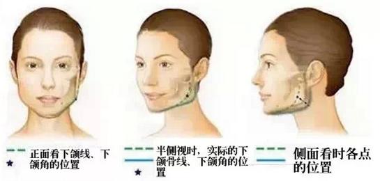 广东美恩磨骨案例(近期网友投稿):脸型自然流畅,大小脸不见了~