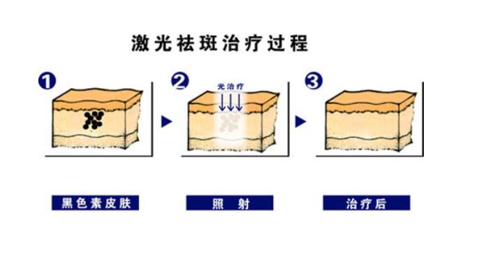 激光能去黄褐斑吗?会不会反弹?有色素沉着吗?