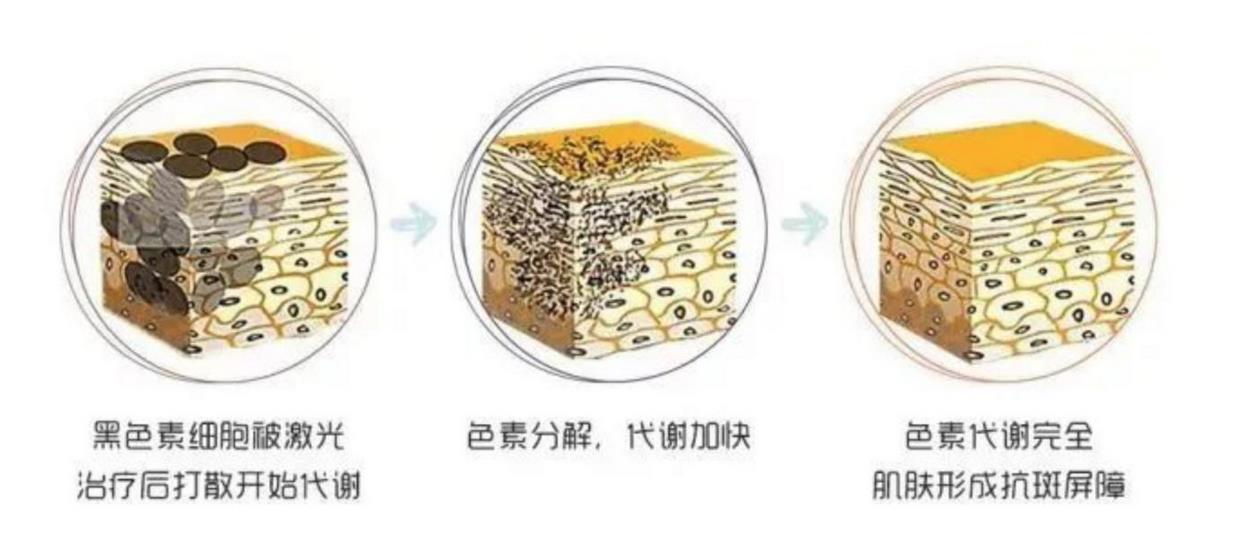激光能去黄褐斑吗?会不会反弹?有色素沉着吗?