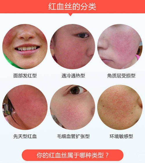 中南大学湘雅医院激光去红血丝多少钱?怎么样?价格明细_网友恢复日记