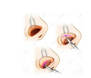 奥美定隆鼻有什么副作用?注意事项有哪些?附价格介绍~