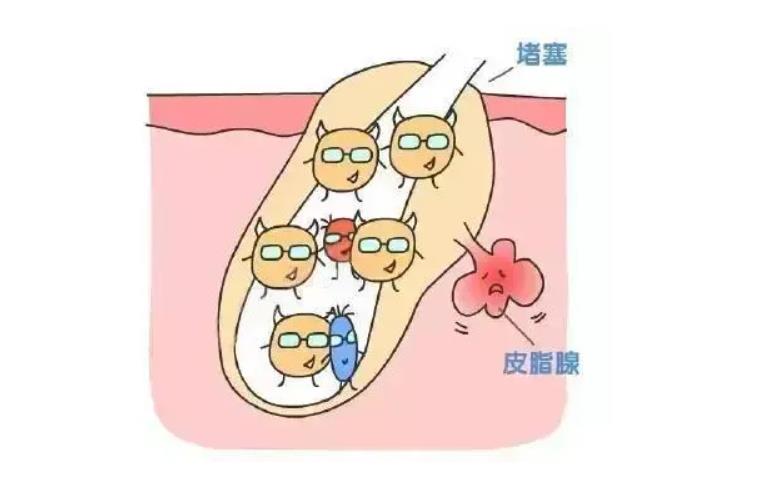北京八大处激光祛痘印怎么样?口碑实力-张波简介-网友案例