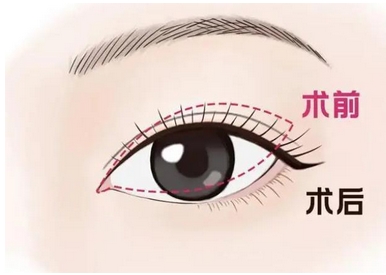 长沙市岳麓区卓而美医疗美容门诊部怎么样?双眼皮修复案例揭晓,受欢迎的秘密!