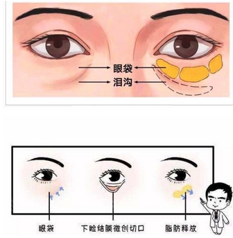 自体脂肪填充泪沟能保持几年?能成活多少?技术优势带你认识~