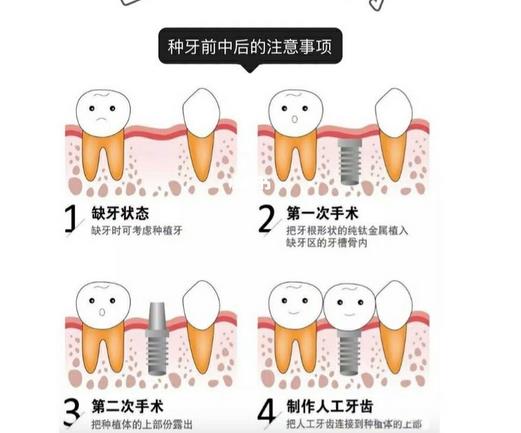 北京佳美口腔医院牙齿种植技术