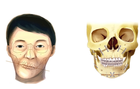北京安贞医院杨斌颅颌面畸形怎么样?下颌角整形案例揭秘!附医生技术资料~
