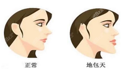 北京安贞医院杨斌颅颌面畸形怎么样?下颌角整形案例揭秘!附医生技术资料~