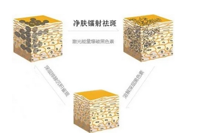 镭射净肤的作用与果怎么样?祛斑、美白又嫩肤?哪种更让你心动~