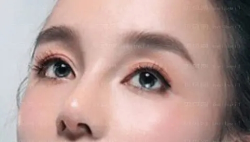 皮庆猛做双眼皮怎么样?技术特长介绍,双眼皮案例揭秘!