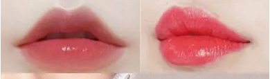 玻尿酸丰唇整形多久消肿?副作用有哪些|成全你的性感“嘟嘟唇”目标~