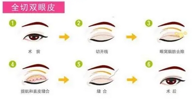 合肥美刻整形医院是不是正规医院?双眼皮项目怎么样?技术展现|医生介绍~