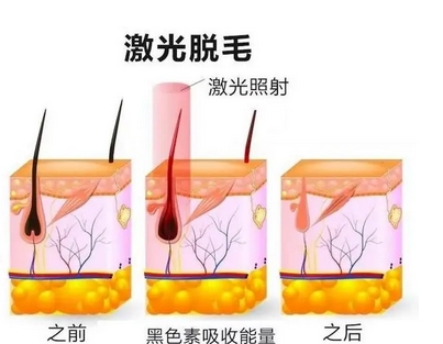 安徽医科大学第一附属医院可以做激光脱毛吗?熟练掌握脱毛技术!附美容中心医生介绍~
