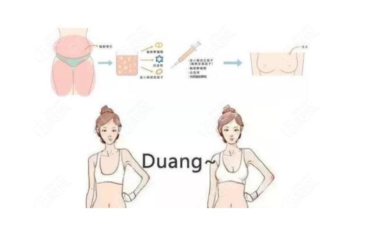 成都蓉美和谐医院怎么样?赵兴阳医生简介-脂肪丰胸案例