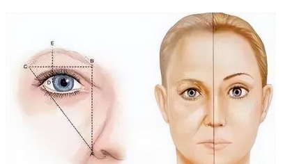 双眼皮之后出现三眼皮能恢复吗?埋线、微创-全切看看那种更适合你~