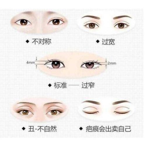北医三院薛红宇双眼皮怎么样?价格费用明细-双眼皮3个月恢复日记