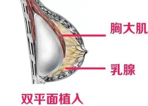 徐华隆胸怎么样?医生简介分析,看具体案例反馈~