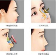 北京协和医院王阳隆鼻案例:术后2个月的变化简直了！妥妥妈生鼻~