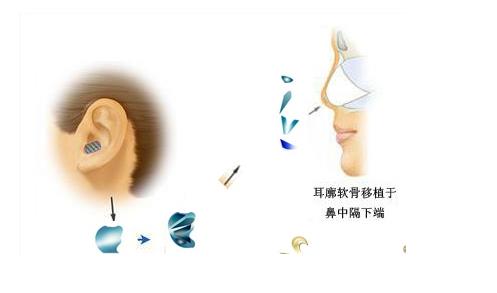 张金明做鼻整形怎么样?分享医生技术实力,价格表预览!