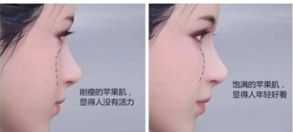 脂肪填充苹果机可靠吗?填充苹果肌太鼓怎么办?脸蛋圆圆,饱满有活力~